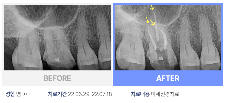 미세신경치료