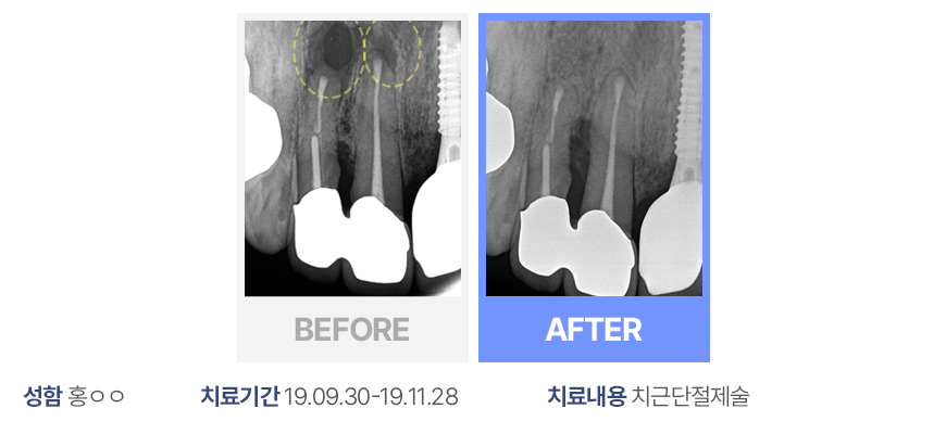 치근단절제술