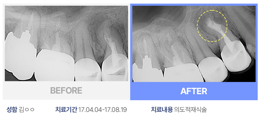 의도적재식술