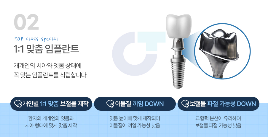 1:1 맞춤 임플란트